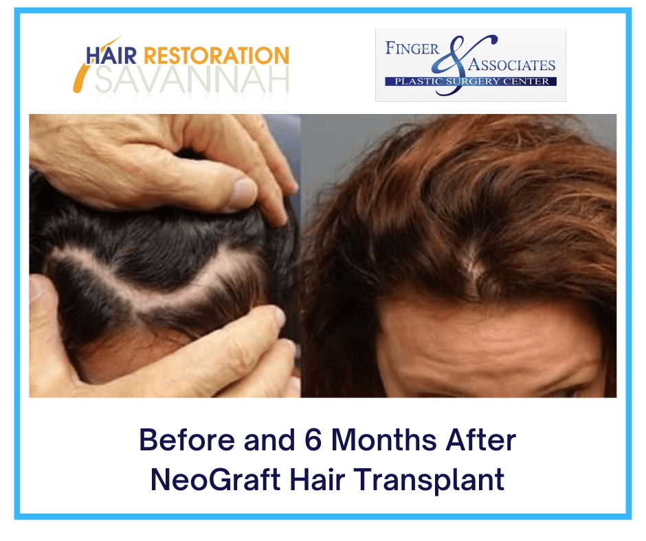 Before and 6 Months After NeoGraft Transplant Before-and-6-Months-After-NeoGraft-Transplant