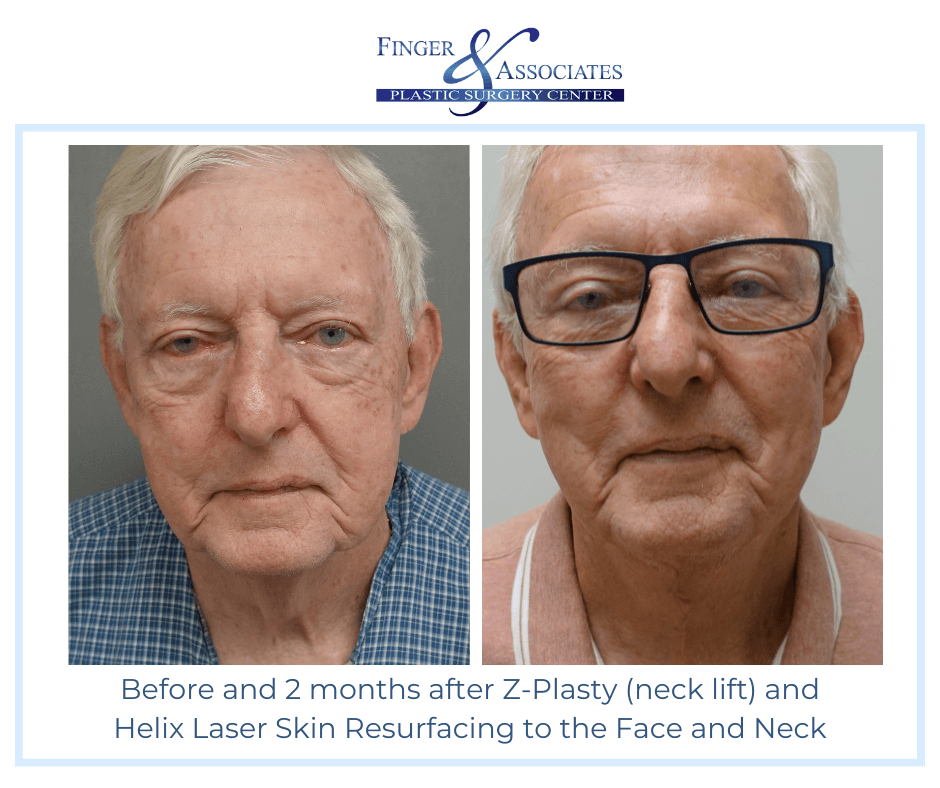 Before and 2 months after Z Plasty and Helix Fusion to Face and Neck- Finger and Associates