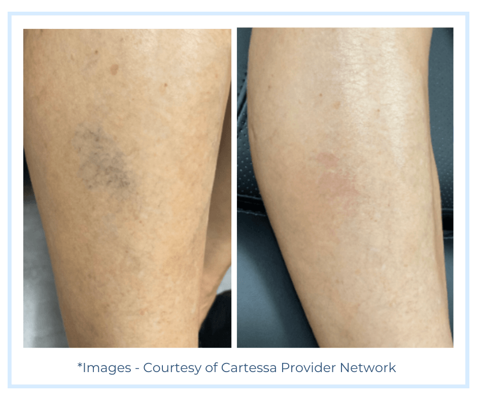 Before and After Chrome Lase Station