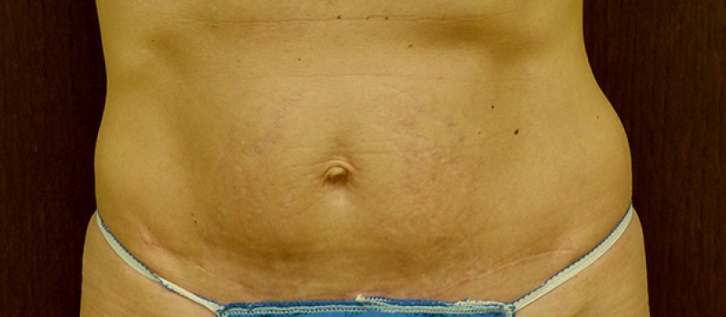 mini tummy tuck recovery week by week mini tummy tuck recovery week by week